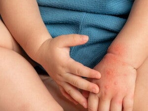 Cara Tes Alergi Susu Sapi Pada Bayi 