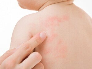 Kenali Penyebab Alergi Susu Formula pada Bayi Ini!  