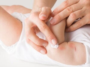 Ruam Alergi Susu Sapi: Penyebab, Gejala, dan Cara Mengatasinya 