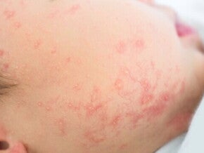 Gejala Alergi Susu Sapi : Tanda-Tanda yang Mam Harus Mam Perhatikan