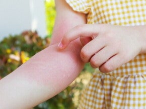 Kenali Penyebab Biduran pada Anak dan Cara Mengatasinya.jpg