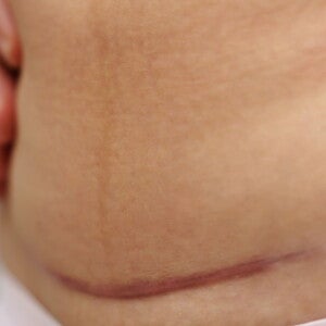 Ketahui Melahirkan Secara Caesar Sekaligus Sterilisasi