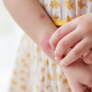 Alergi Makanan pada si Kecil: Gejala, Penyebab, dan Cara Mengatasinya  