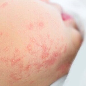 Cek Alergi Anak_Langkah Penting untuk Kesehatan Si Kecil.jpg