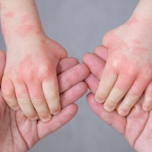 Ciri-ciri Alergi Susu Sapi pada si Kecil dan Cara Pencegahannya  