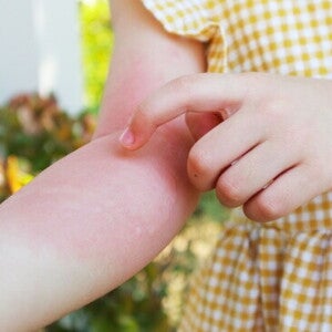 Kenali Penyebab Biduran pada Anak dan Cara Mengatasinya.jpg