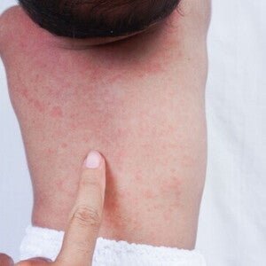 Penyebab dan Cara Mengatasi Alergi Susu Pada Bayi