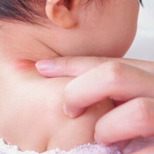 Tips dan Trik Mengatasi Ruam Kulit Alergi Pada Si Kecil