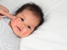 Dermatitis Atopik Pada Bayi: Kenali Penyebab dan Perawatannya
