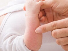 Cara Mencegah Alergi Pada Bayi dengan Tepat (1).jpg