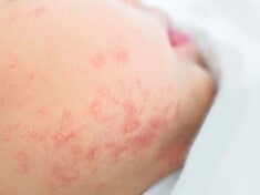 Cek Alergi Anak_Langkah Penting untuk Kesehatan Si Kecil.jpg